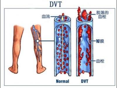靜脈血栓的預防以及它的治療方法