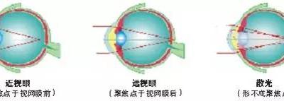 關于散光，這些你都了解嗎？